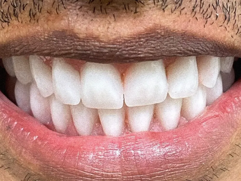 Limpeza e clareamento — depois