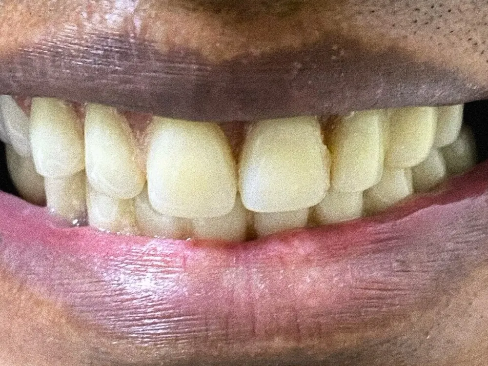 Limpeza e clareamento — antes