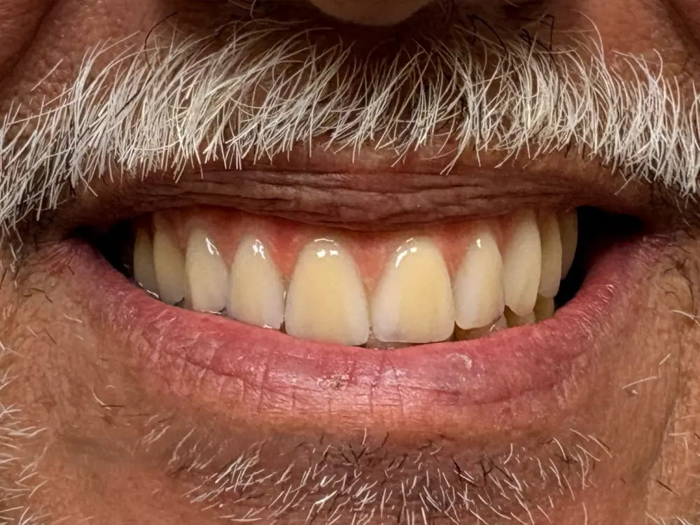 Reconstituição do sorriso — depois